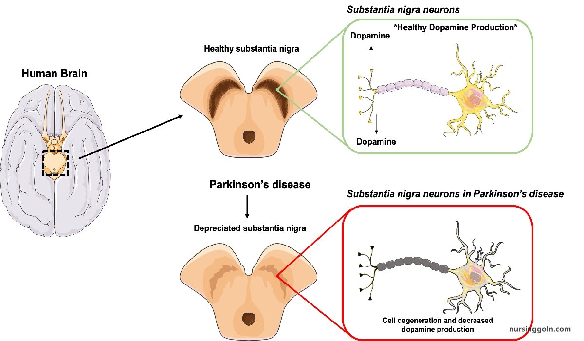 Parkinsons disease (PD) | CHAPTER-14 | Medical and Surgical Nursing