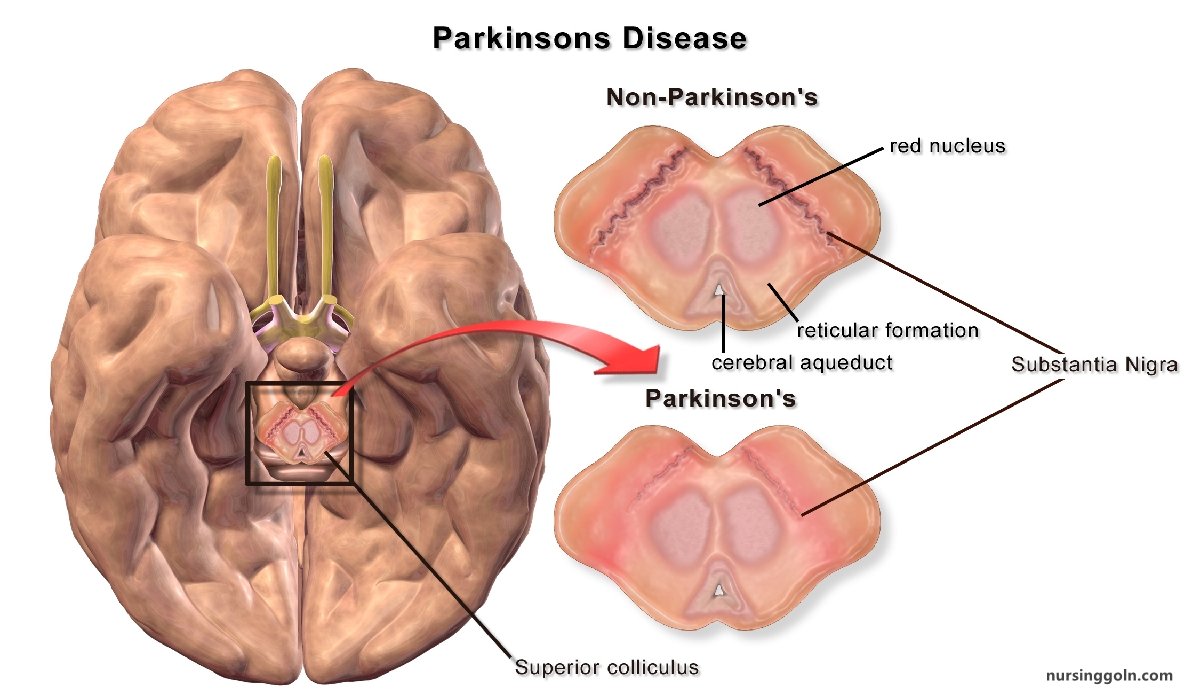 Parkinsons disease (PD) | CHAPTER-14 | Medical and Surgical Nursing