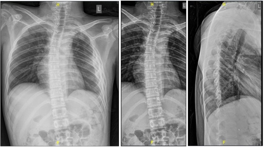 Concept about Ewing's sarcoma | CHAPTER 16 | Orthopedic Nursing
