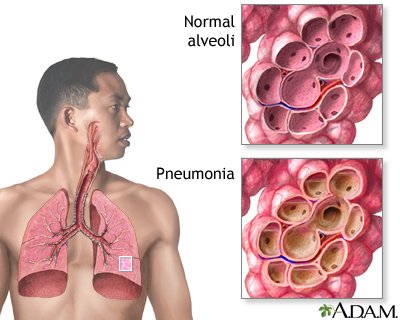 Medical Definition of Pneumonia | CHAPTER-8 | Medical and Surgical Nursing