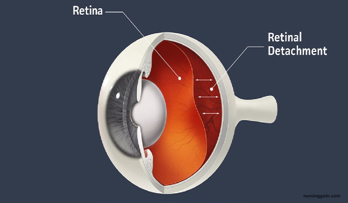 Retinal detachment | CHAPTER-10 | Medical and Surgical Nursing