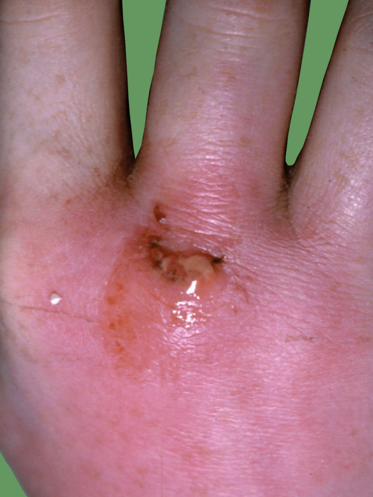 Septic arthritis | CHAPTER 15 | Orthopedic Nursing