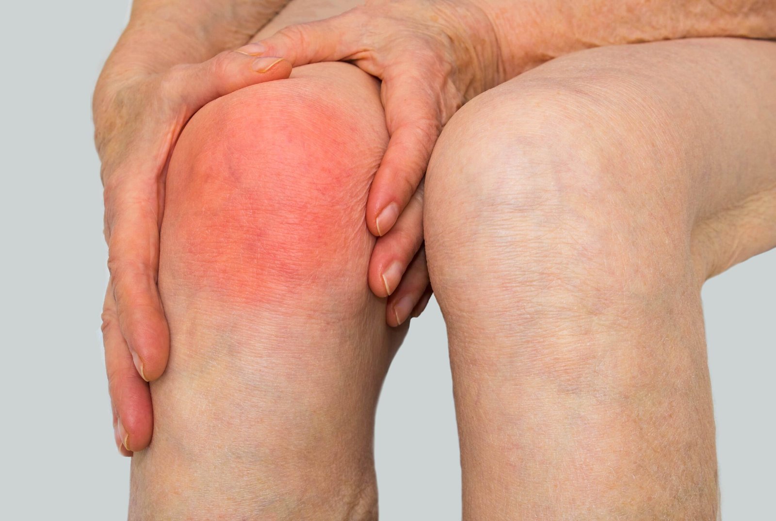 Septic arthritis | CHAPTER 15 | Orthopedic Nursing