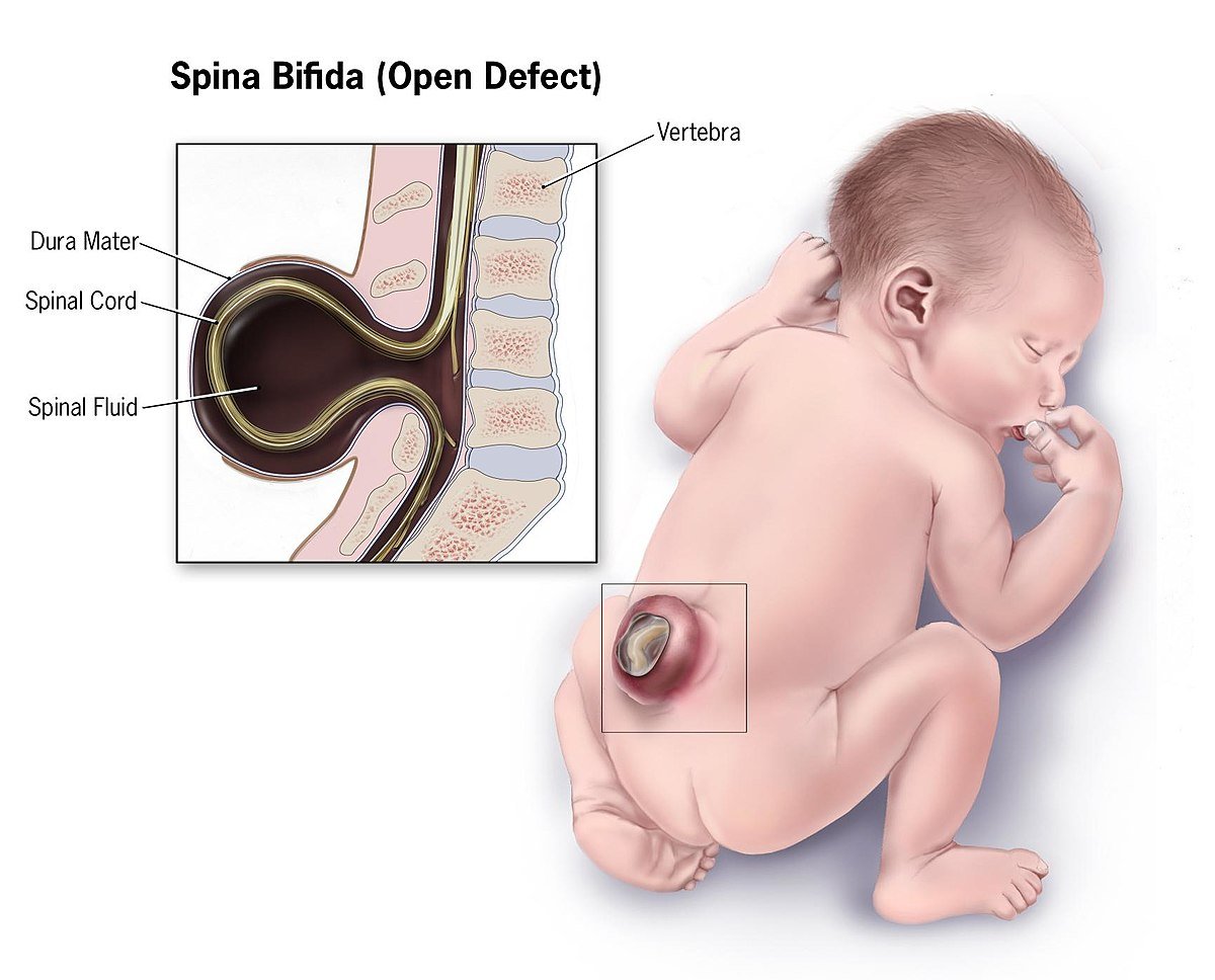 Spina Bifida | CHAPTER 19 | Orthopedic Nursing