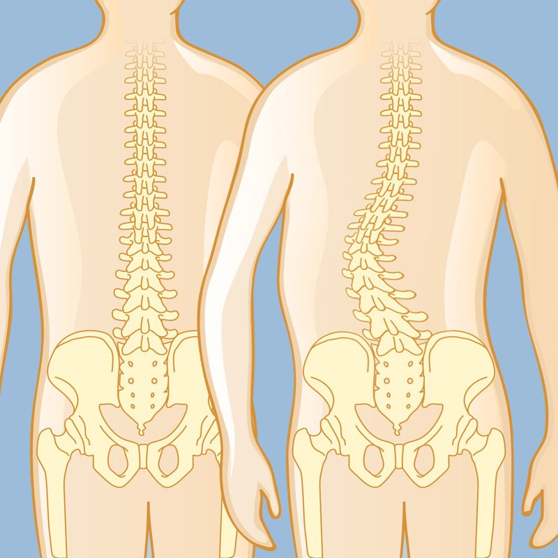 Definition of Arthrodesis | CHAPTER 10 | Orthopedic Nursing
