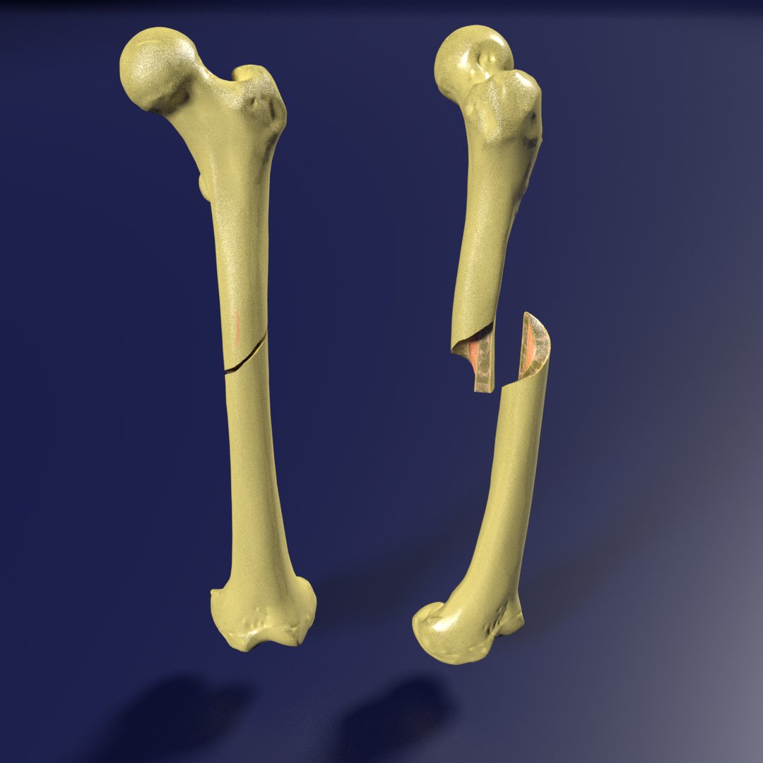 Medical Definition of Fracture