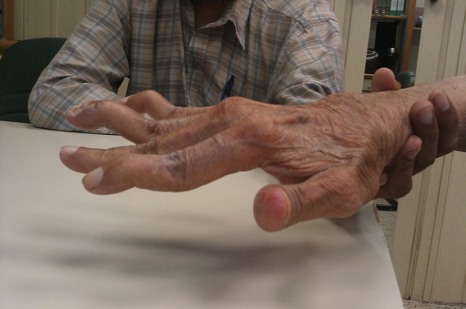 Rheumatoid Arthritis | CHAPTER 12 | Orthopedic Nursing