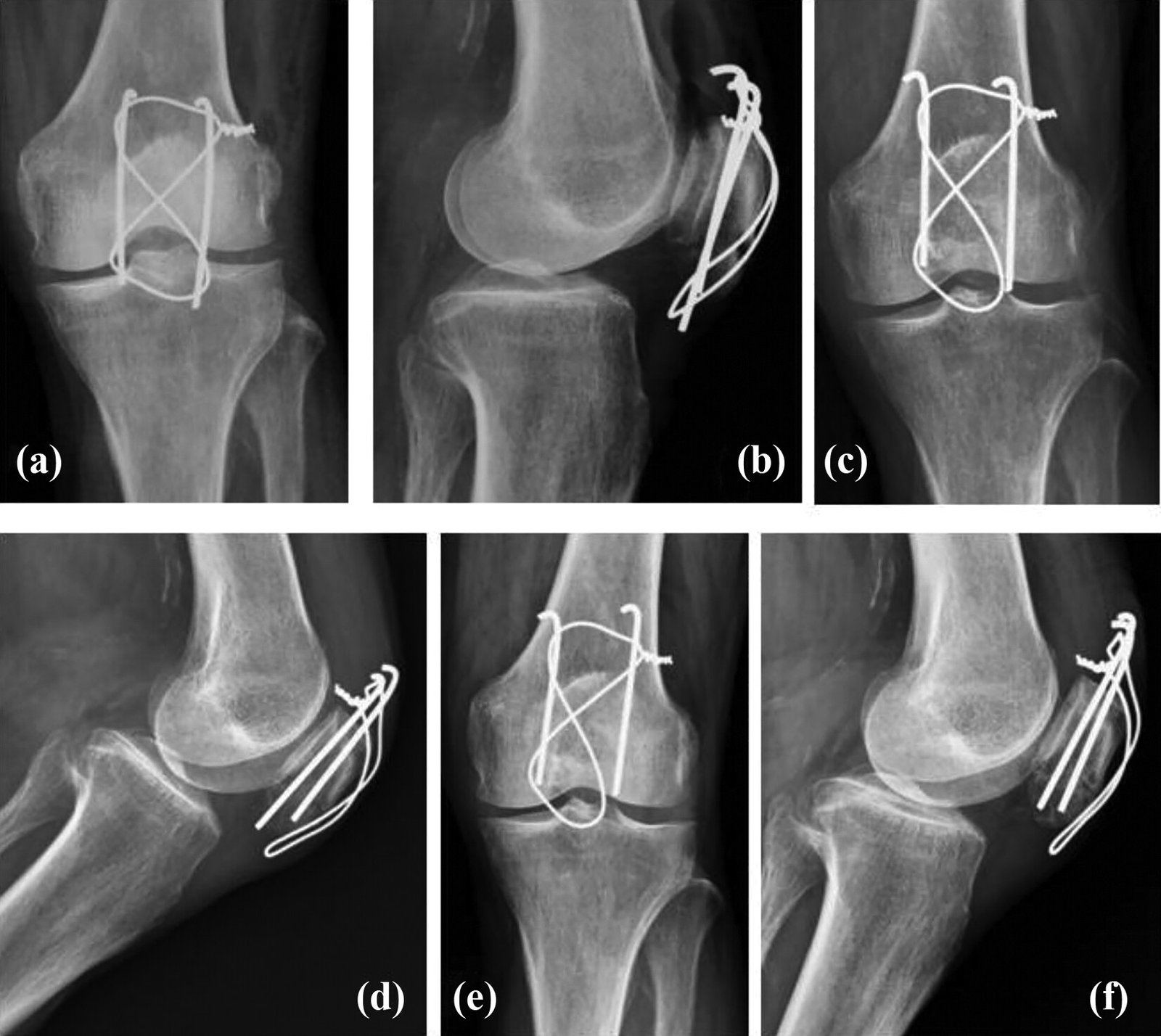 Fracture of Patella | CHAPTER 5 | Orthopedic Nursing