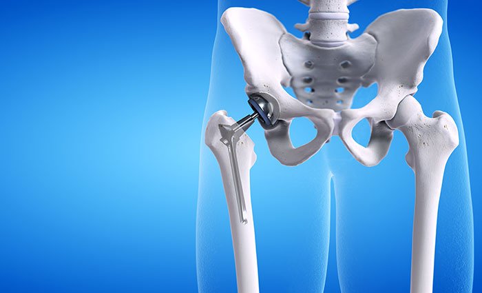 Hip arthoplasty | CHAPTER 11 | Orthopedic Nursing