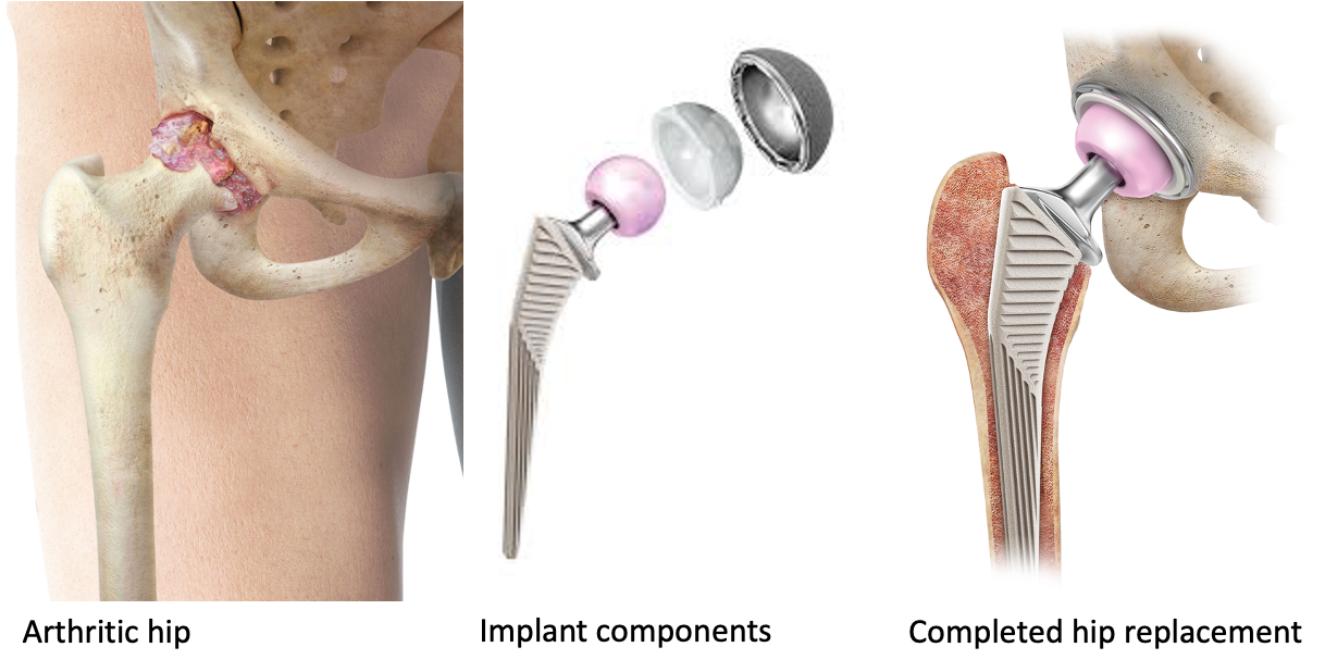 Hip arthoplasty | CHAPTER 11 | Orthopedic Nursing