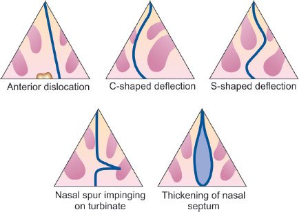 Types of Deviated Septum