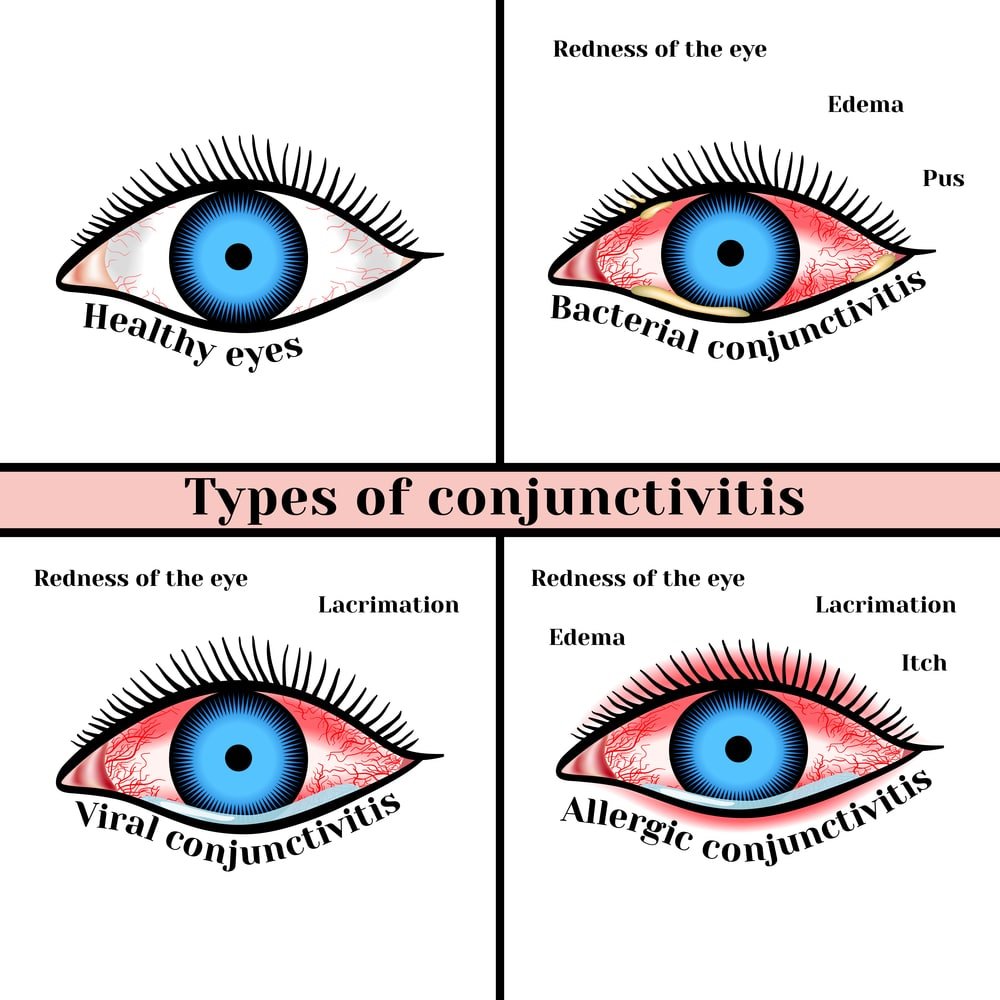 Types of conjunctivitis