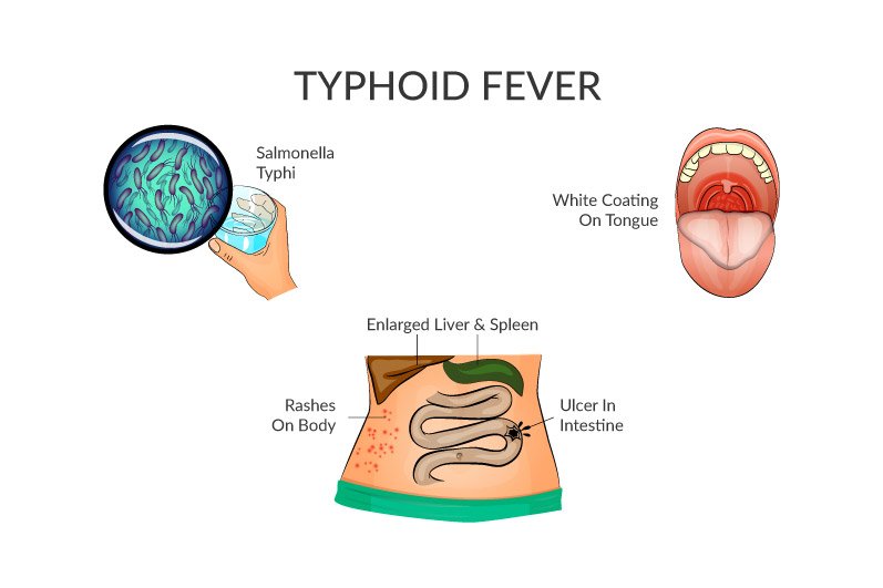 typhoid fever