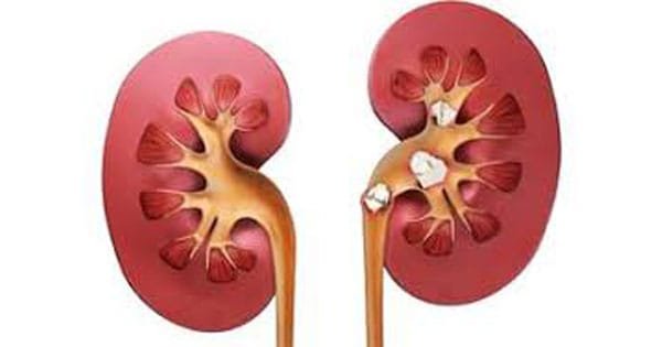 Definition of Urolithiasis | Chapter 7 | Medical And Surgical Nursing