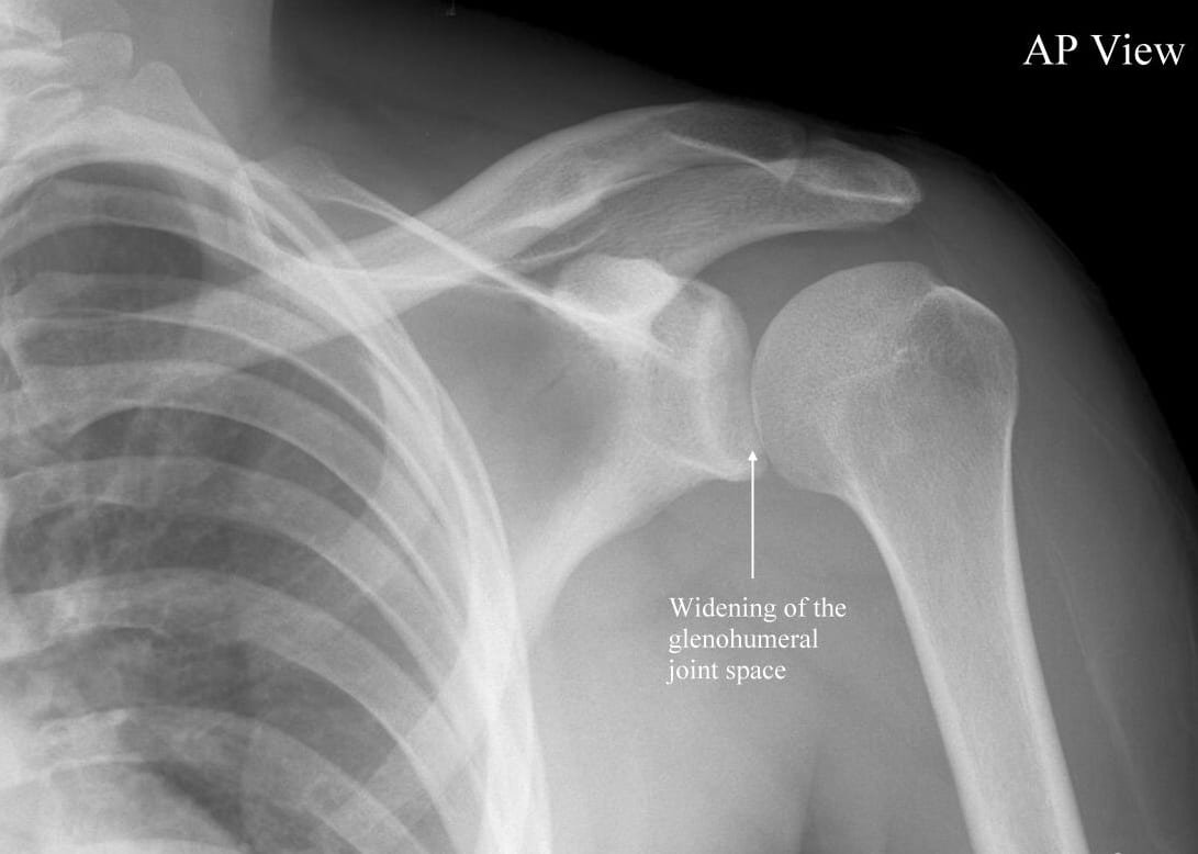 Anterior shoulder dislocation | CHAPTER 6 | Orthopedic Nursing