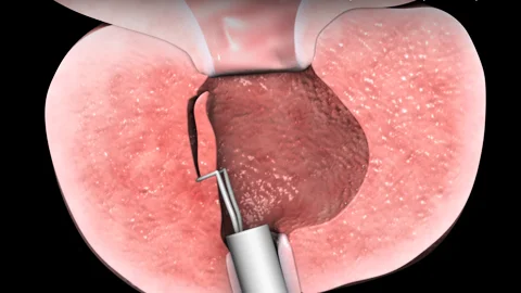Benign Enlargement of Prostate (BEP)/(BPH) | Chapter 7 | Medical And Surgical Nursing