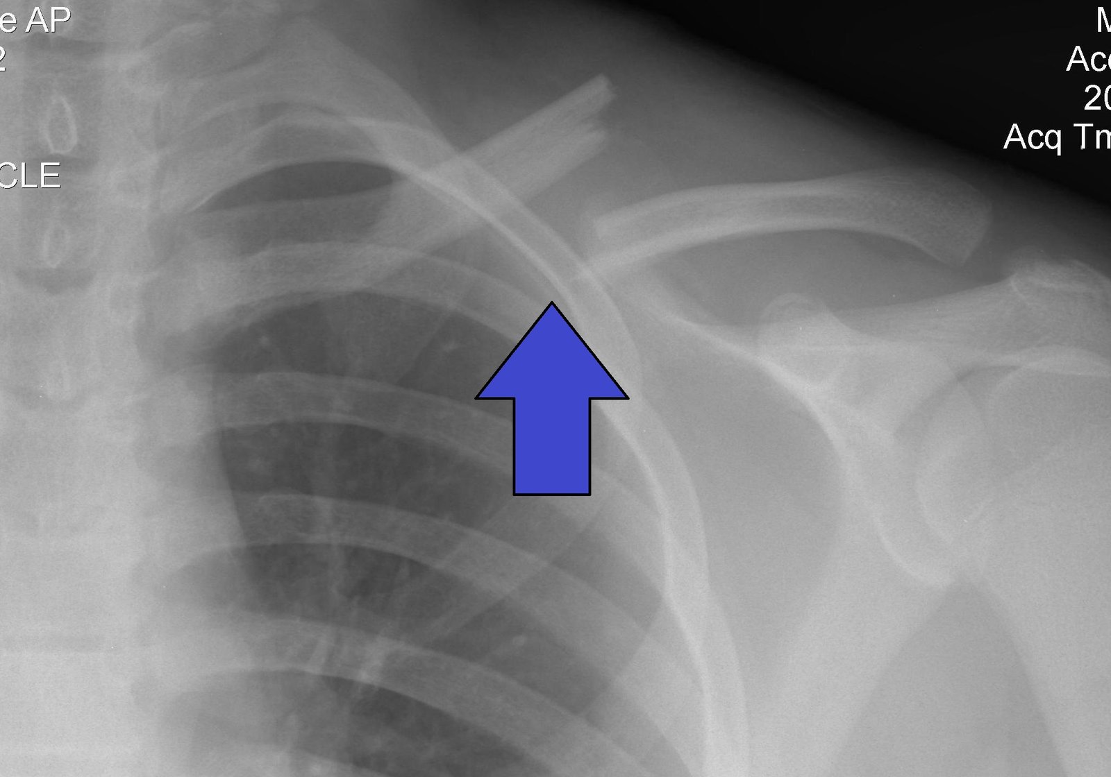 Fracture of clavicle | CHAPTER 5 | Orthopedic Nursing
