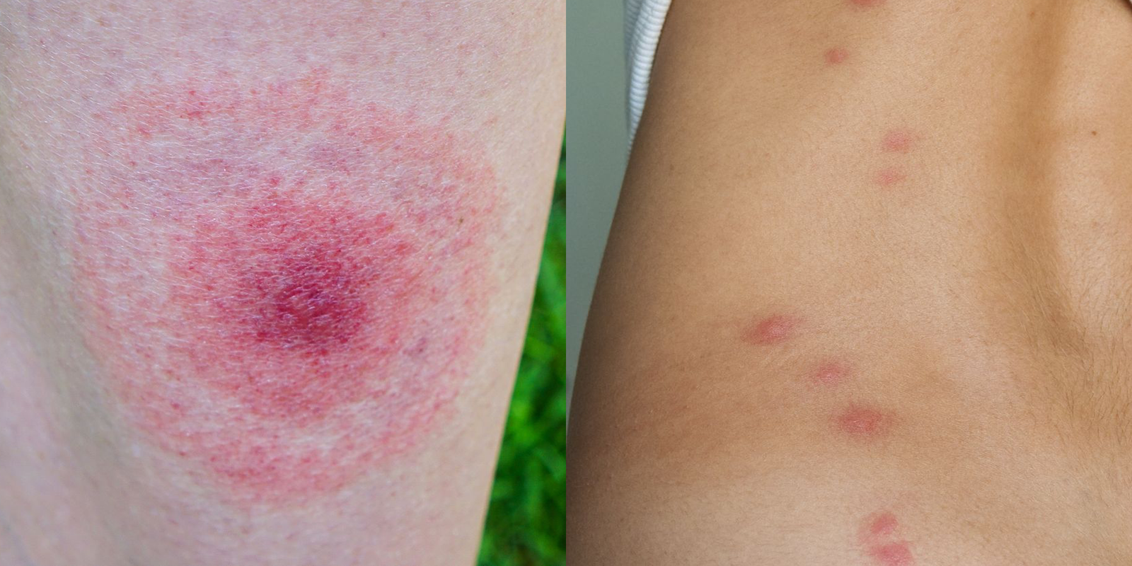 Insect bites | CHAPTER 22 | Fundamentals of Nursing