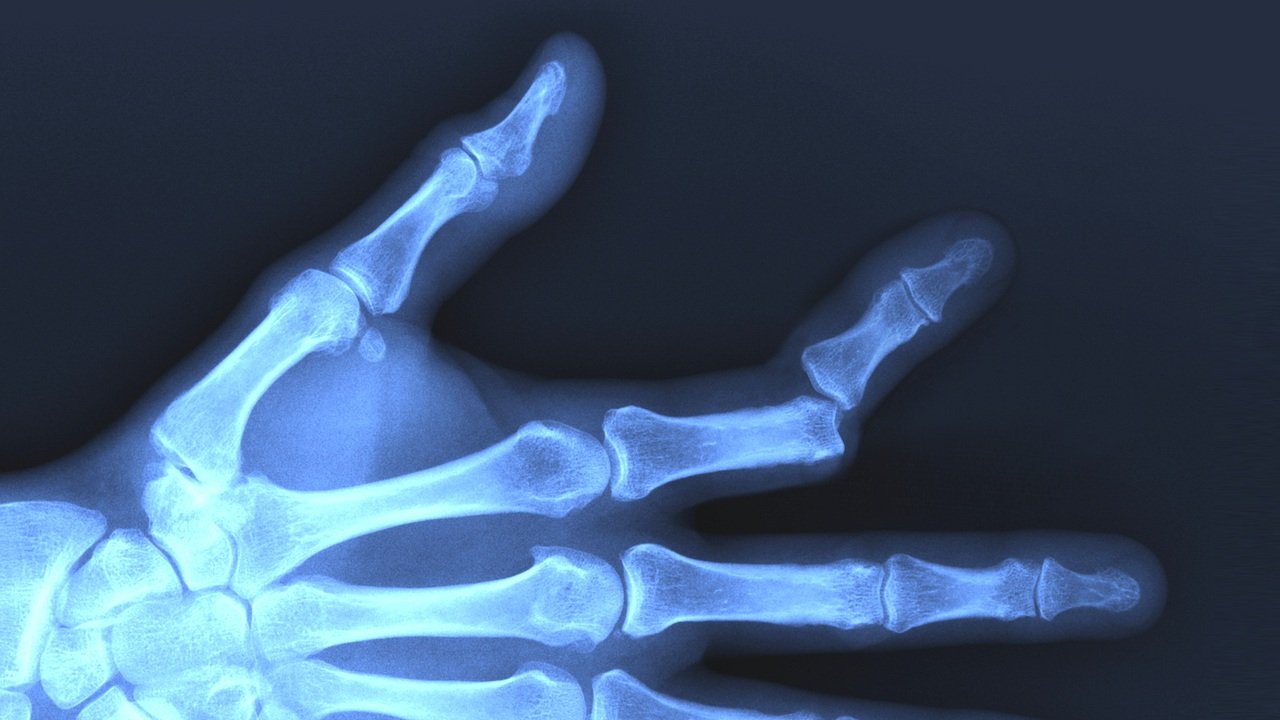 Definition of Dislocation | CHAPTER 21 | Fundamentals of Nursing 