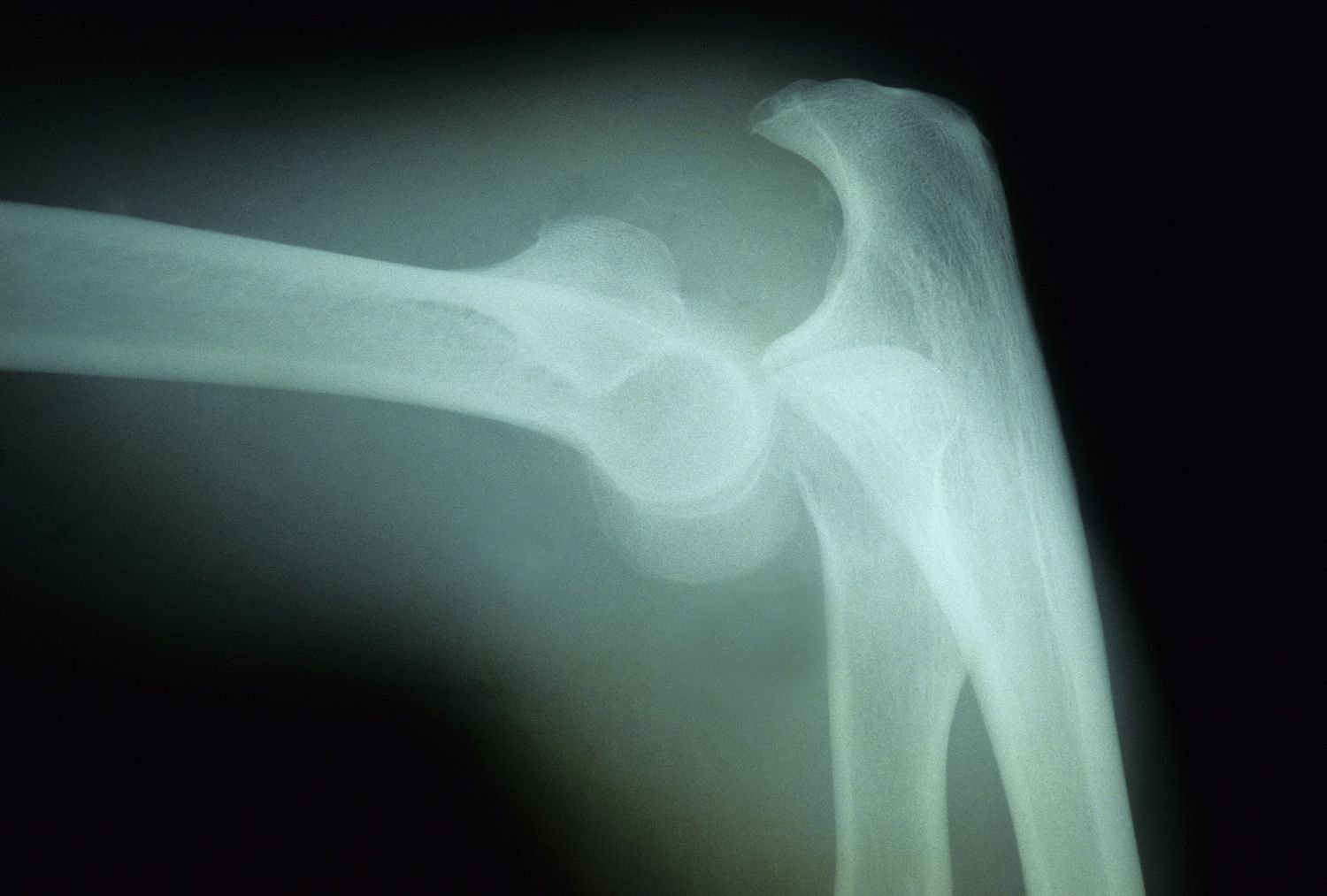 Definition of Dislocation | CHAPTER 21 | Fundamentals of Nursing 