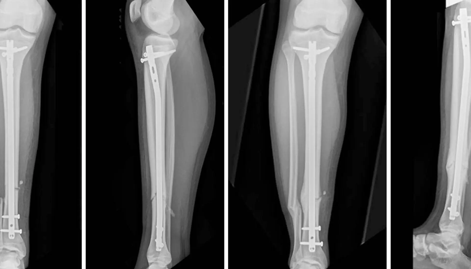 Definition Intramedullary (IM) Nail
