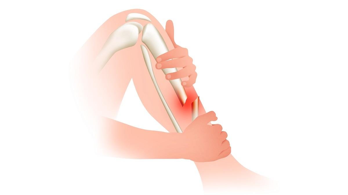 Open Fracture | CHAPTER 5 | Orthopedic Nursing