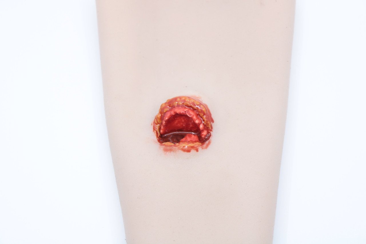 Open Fracture | CHAPTER 5 | Orthopedic Nursing