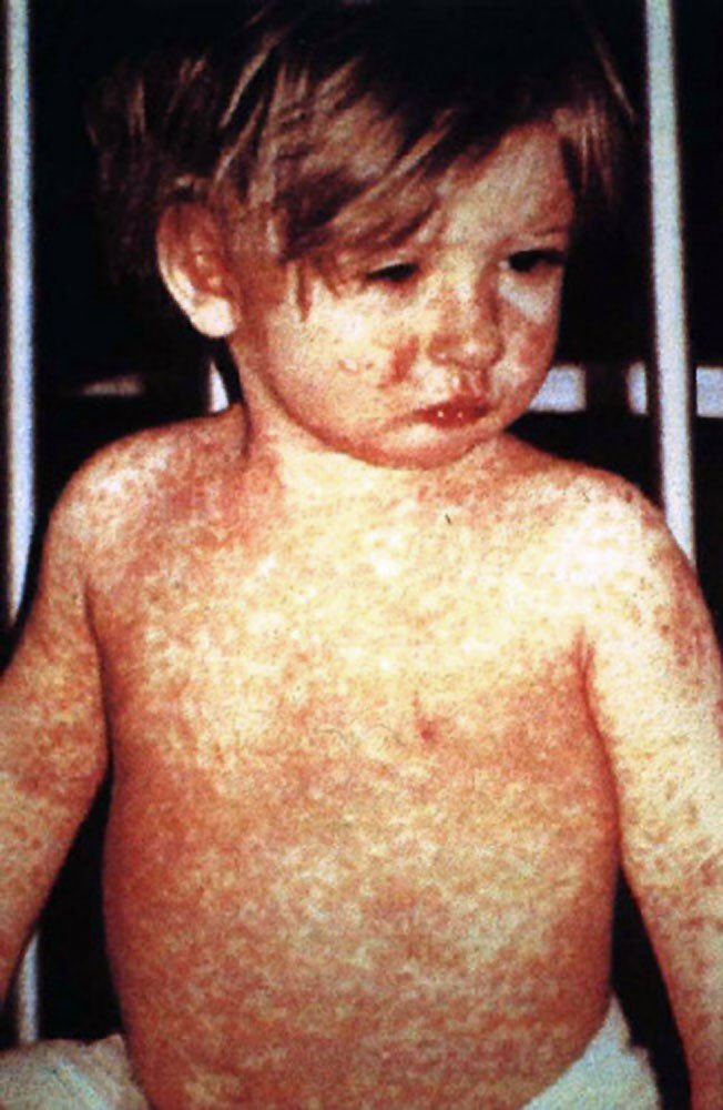 All About Measles