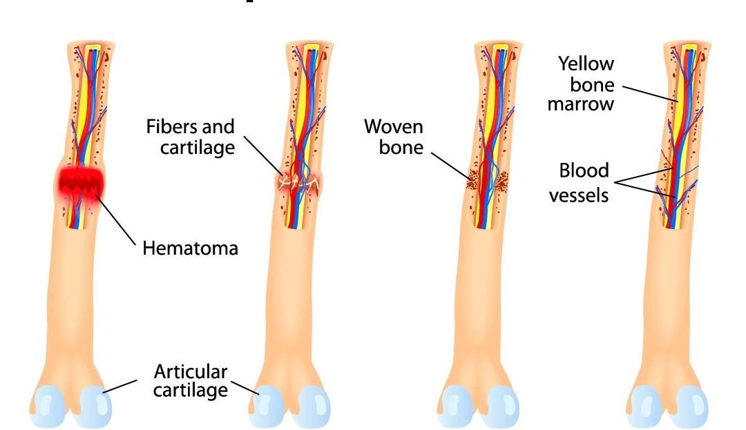 Definition of fracture | CHAPTER 5 | Orthopedic Nursing