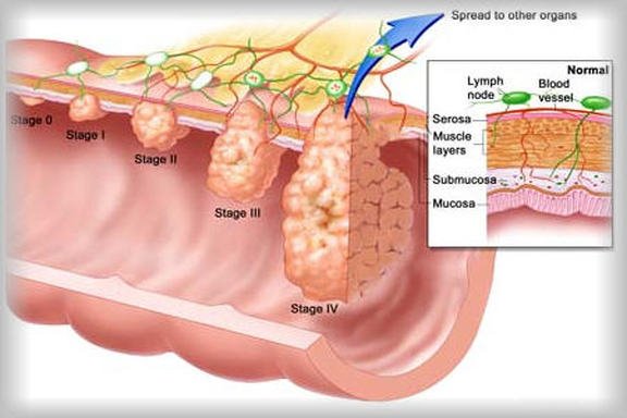 Concept about Osteosarcoma | CHAPTER 15 | Orthopedic Nursing