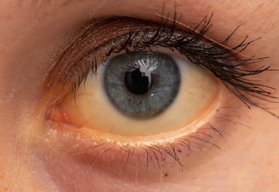 Jaundice In Pregnancy | Chapter 12 | Midwifery For Diploma In Nursing