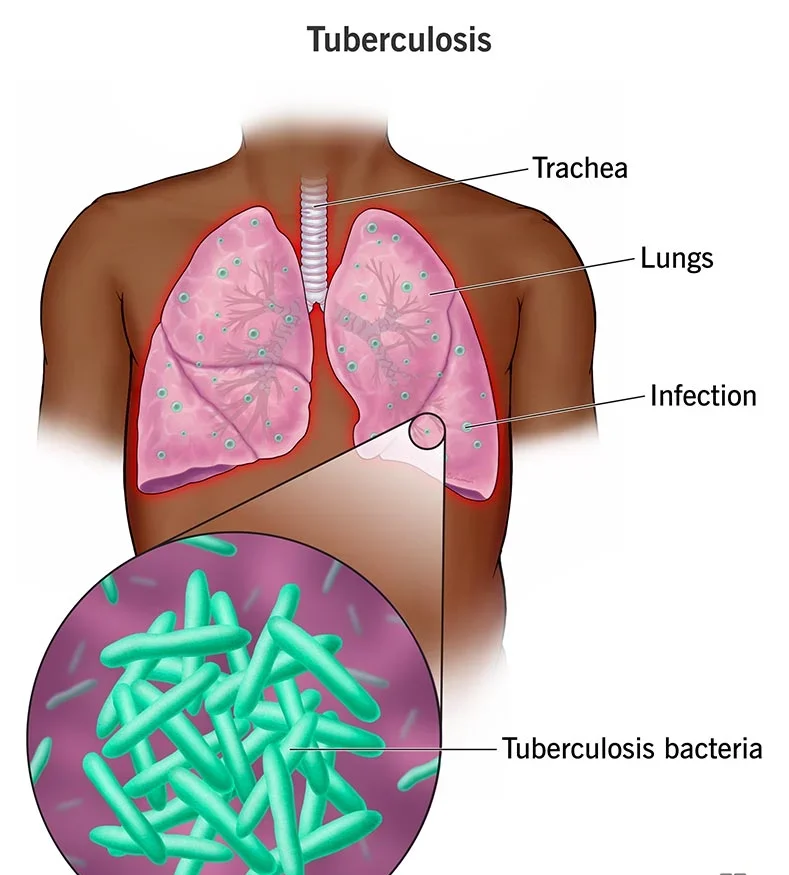 Definiton of Tuberculosis | Chapter 12 | Midwifery For Diploma In Nursing
