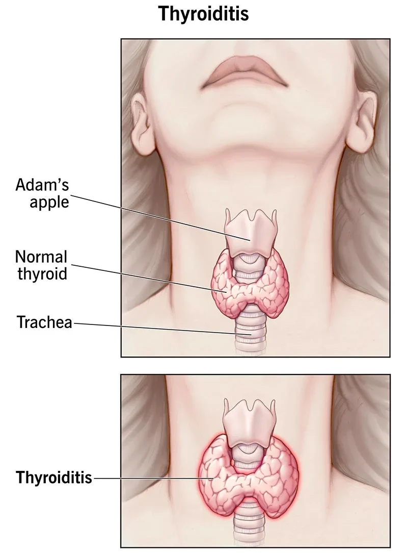 Definition of Hypothyroidism | Chapter 12 | Midwifery For Diploma In Nursing