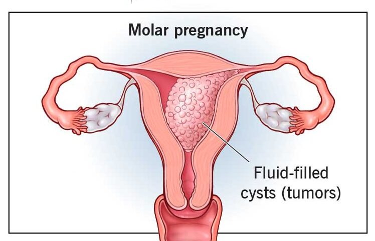 Hydatidiform Mole | Chapter 17 | Midwifery For Diploma In Nursing