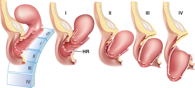 Uterine Inversion | Chapter 17 | Midwifery For Diploma In Nursing