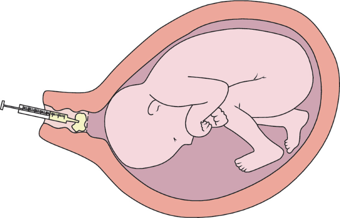 Induction of Labour | Chapter 15 | Midwifery For Diploma In Nursing