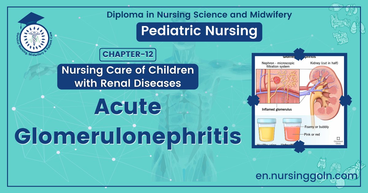 Medical Acute glomerulonephritis | CHAPTER 12 | Pediatric Nursing