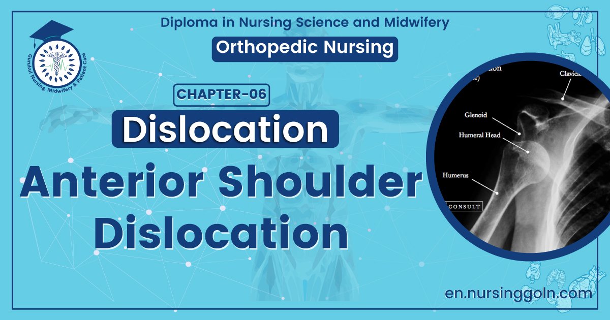 Anterior shoulder dislocation | CHAPTER 6 | Orthopedic Nursing