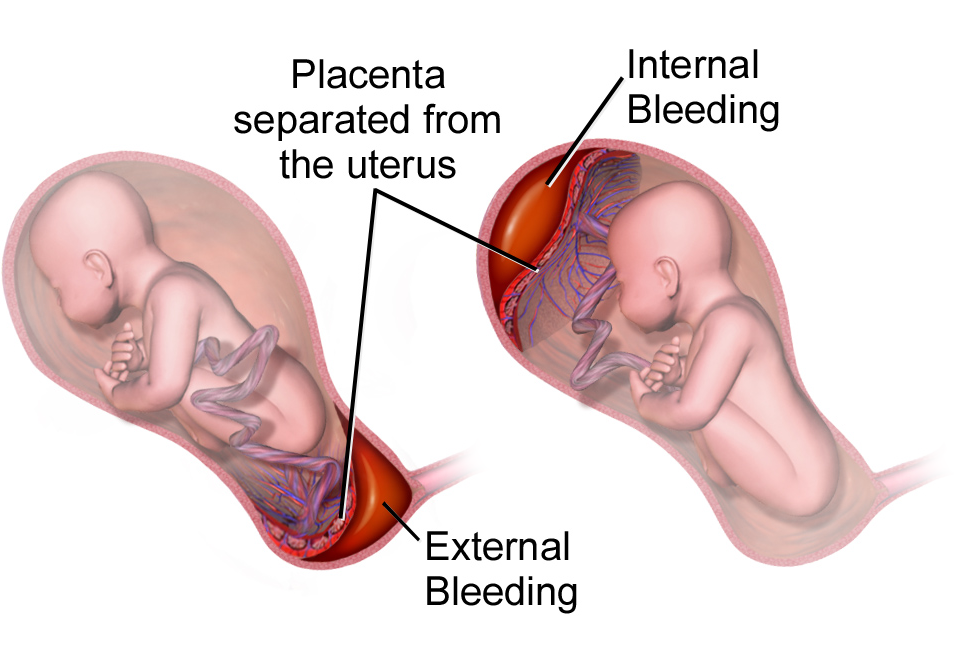 Placenta Praevia | Chapter 11 | Midwifery For Diploma In Nursing