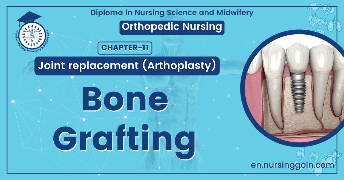 Medical Bone Grafting | CHAPTER 11 | Orthopedic Nursing
