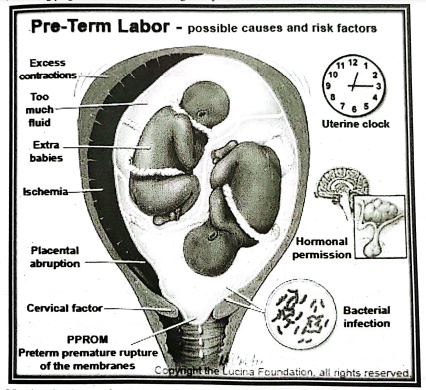 Preterm Labour | Chapter 16 | Midwifery For Diploma In Nursing