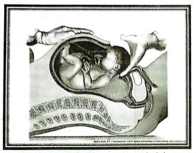 Prolong labour | Chapter 17 | Midwifery For Diploma In Nursing