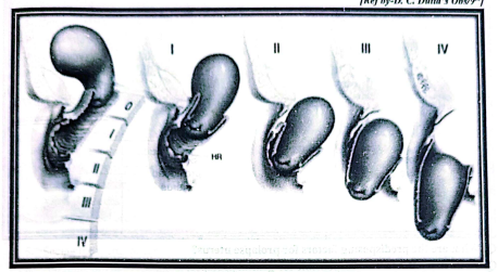 Genital Prolapse | Chapter 17 | Midwifery For Diploma In Nursing