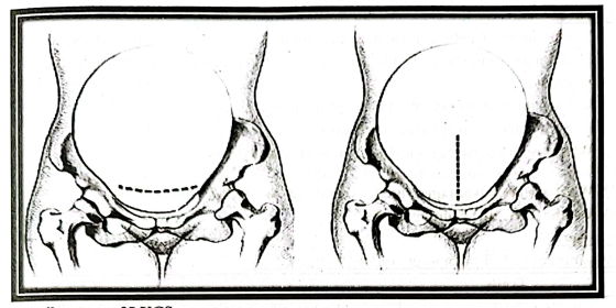 Caesarean section | Chapter 16 | Midwifery For Diploma In Nursing