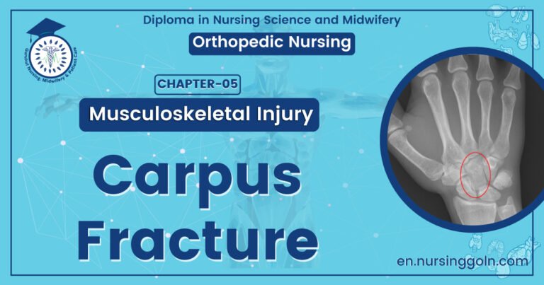 Carpus fracture | CHAPTER 5 | Orthopedic Nursing