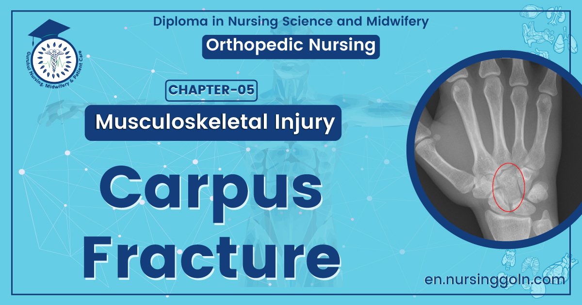 Carpus fracture | CHAPTER 5 | Orthopedic Nursing