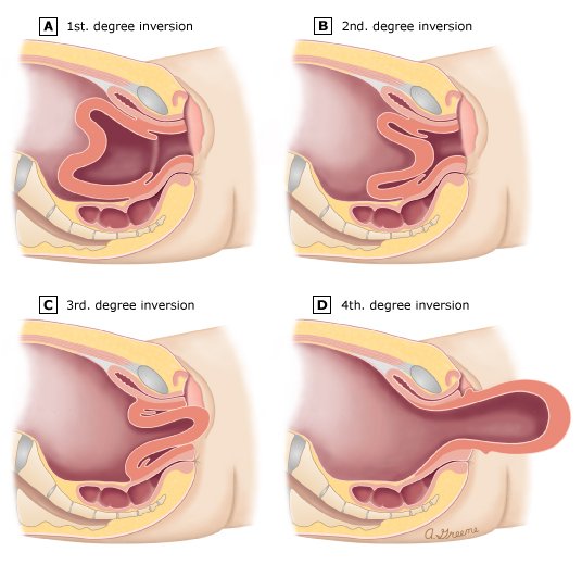 Uterine Inversion | Chapter 17 | Midwifery For Diploma In Nursing