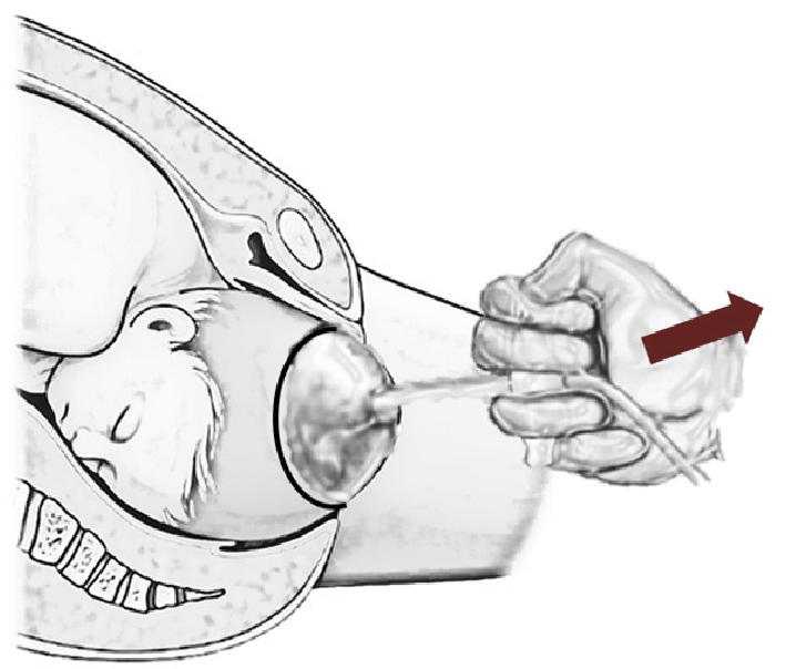 Vacuum extraction/ventouse delivery | Chapter 16 | Midwifery For Diploma In Nursing