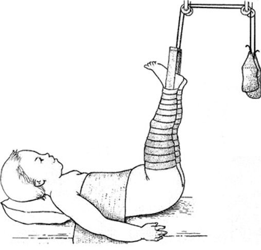 Skin Traction | CHAPTER 21 | Orthopedic Nursing