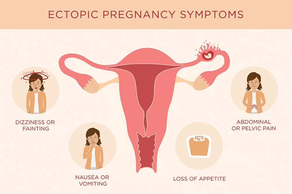 ectopic pregnancy